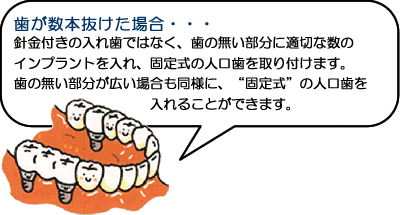 歯が数本抜けた場合・・・針金付きの入れ歯ではなく、歯の無い部分に適切な数のインプラントを入れ、固定式の人工歯を取り付けます。歯の無い部分が広い場合も同様に、”固定式”の人口歯を入れることができます。